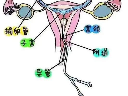 输卵管堵塞怎么能治好