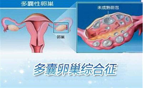多囊卵巢最快受孕方法是什么?7招助你成功怀孕!