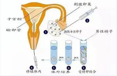 什么是试管婴儿取卵