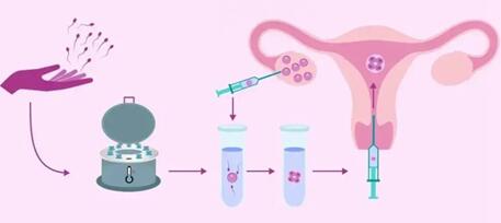 试管剖腹产后一年再移植可不可以看这,试管剖腹产多久可以再次移植?
