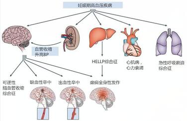 如何诊断妊娠期高血压?孕期怎么预防高血压?