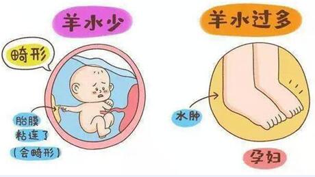 羊水过多会对胎儿造成什么影响?羊水偏多怎么恢复正常?