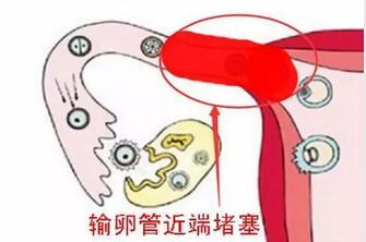 导致输卵管性不孕的原因有哪些?长期吃素会降低生育能力吗?