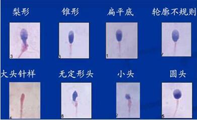 精子头部畸形率多少才正常?什么因素造成精子头部畸形?
