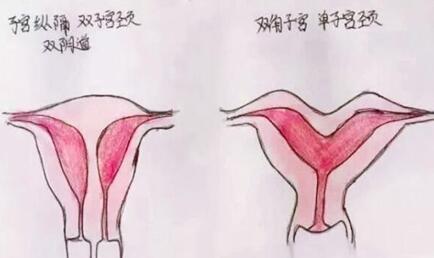 子宫畸形的种类有哪些?子宫畸形患者能做美国试管婴儿吗?