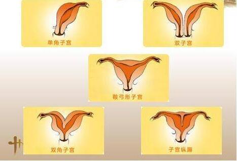 子宫畸形的种类有哪些?子宫畸形患者能做美国试管婴儿吗?