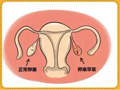 女性得了卵巢早衰怎么护理?为什么卵巢会早衰?