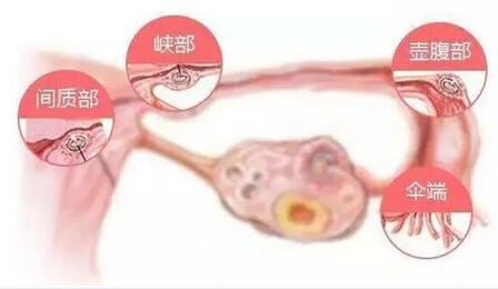 输卵管扭曲会影响怀孕吗?输卵管扭曲有哪些症状?
