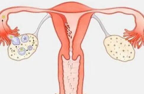 为什么很多女孩患有多囊卵巢？多囊卵巢症是怎么引起的？