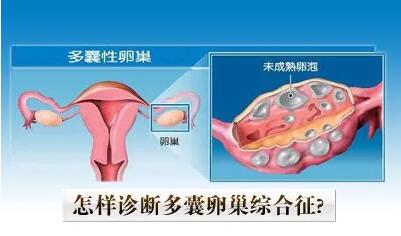 多囊卵巢综合征有什么症状,如何预防多囊卵巢综合征?