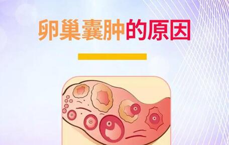 卵巢囊肿是什么原因造成的?多囊卵巢综合症的常见症状有哪些?