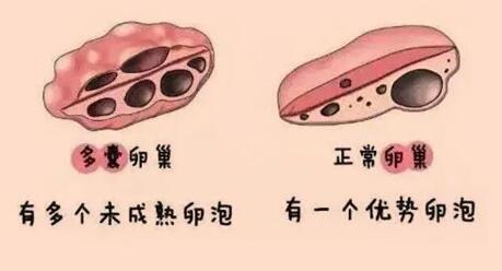 多囊卵巢综合症的囊究竟是什么?做好这4件事很重要!