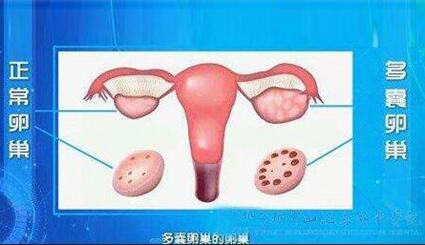 多囊卵巢综合征影响怀孕吗?多囊卵巢和卵巢囊肿有什么区别?