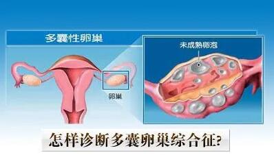多囊卵巢综合征患者可以怀孕吗?怎么判断自己患了多囊?