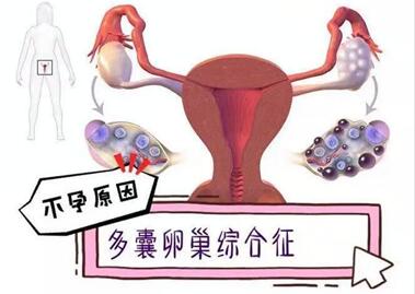 多囊卵巢综合征是遗传病吗?PCOS应该做哪些检查呢?