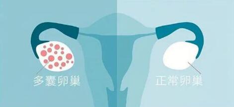 多囊卵巢综合征患者应注意什么?多囊卵巢是什么样的症状?