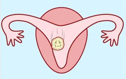 抗子宫内膜抗体阳性可以做试管婴儿吗?