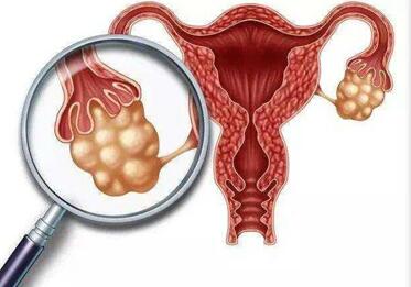 多囊卵巢综合症怀孕后容易胎停吗?
