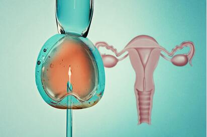 多囊卵巢做试管婴儿成功率高吗?做试管婴儿的必要条件!