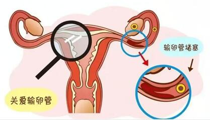 输卵管堵塞有什么样症状?输卵管不通什么原因造成的?