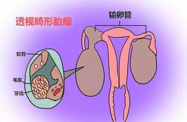 卵巢畸胎瘤手术后需要注意事项,口服叶酸做好孕前准备!
