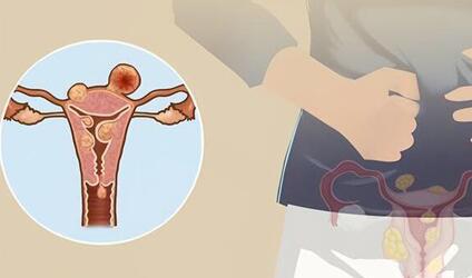 子宫肌瘤会影响月经吗?有这几个症状的注意了!