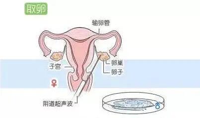 试管婴儿如何进行取卵?流程你都知道吗？