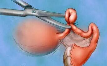 卵巢切除一侧会怀孕吗?卵巢切除一侧后遗症有哪些?