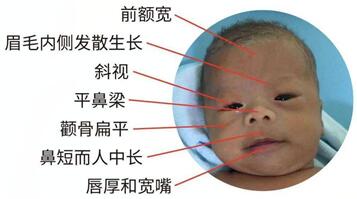 威廉姆斯综合症是什么症状?了解之后才能判断!