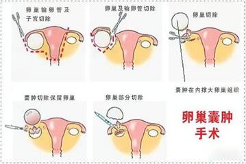 试管取卵前做卵巢囊肿穿刺术作用,远不止提升成功率那么简单!