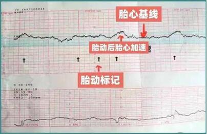 胎心监测不正常是什么原因?解决根本原因才能安心