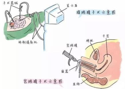 宫腹腔镜是什么意思?宫腹腔镜手术过程是怎样的?