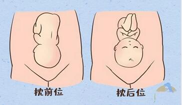 枕前位和枕后位区别,怎么看是枕前位还是枕后位