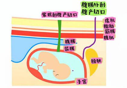 剖腹产子宫和膀胱粘连怎么办?如何预防与治疗