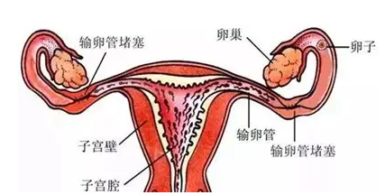 输卵管造影可分为几种